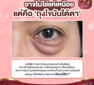 ตัดถุงใต้ตา