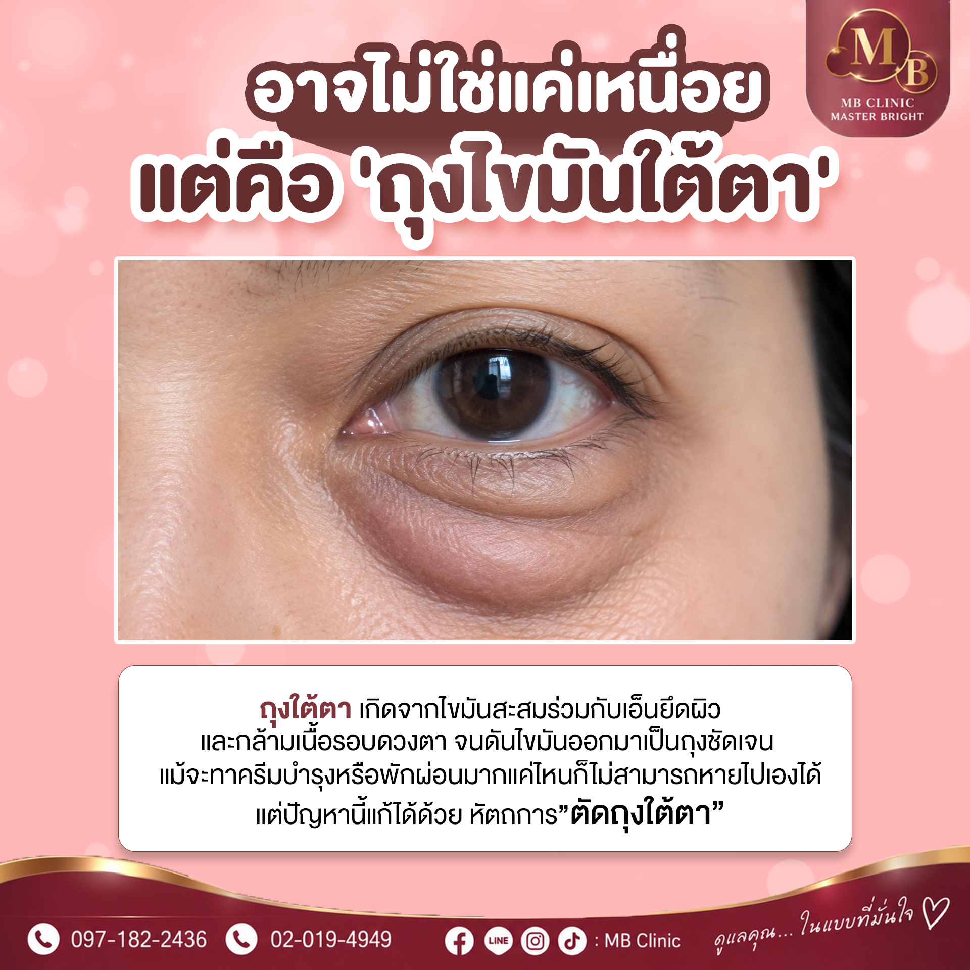 ตัดถุงใต้ตา